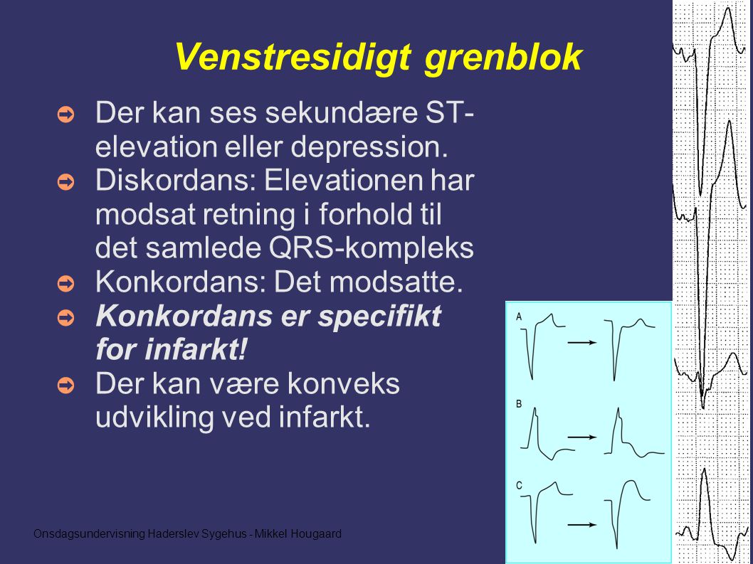 Onsdagsundervisning Haderslev Sygehus - Mikkel Hougaard Venstresidigt grenblok ➲ Der kan ses sekundære ST- elevation eller depression.