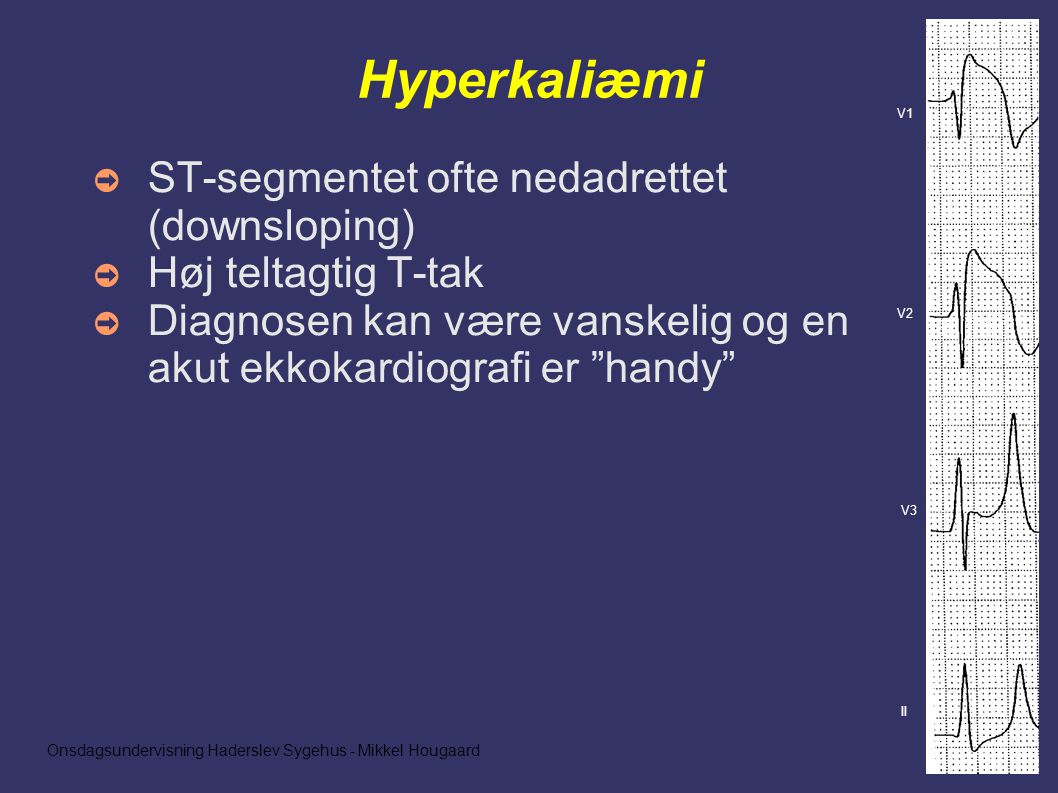 Onsdagsundervisning Haderslev Sygehus - Mikkel Hougaard Hyperkaliæmi ➲ ST-segmentet ofte nedadrettet (downsloping) ➲ Høj teltagtig T-tak ➲ Diagnosen kan være vanskelig og en akut ekkokardiografi er handy II V3 V2 V1
