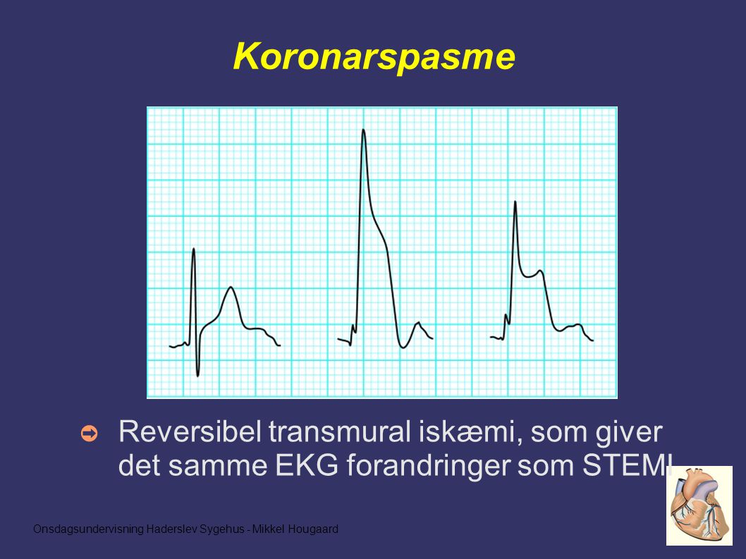 Onsdagsundervisning Haderslev Sygehus - Mikkel Hougaard Koronarspasme ➲ Reversibel transmural iskæmi, som giver det samme EKG forandringer som STEMI