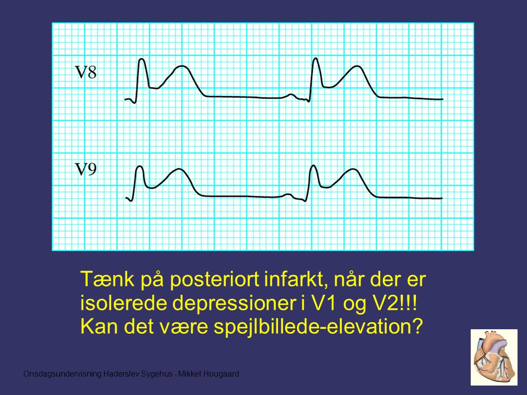 Tænk på posteriort infarkt, når der er isolerede depressioner i V1 og V2!!.