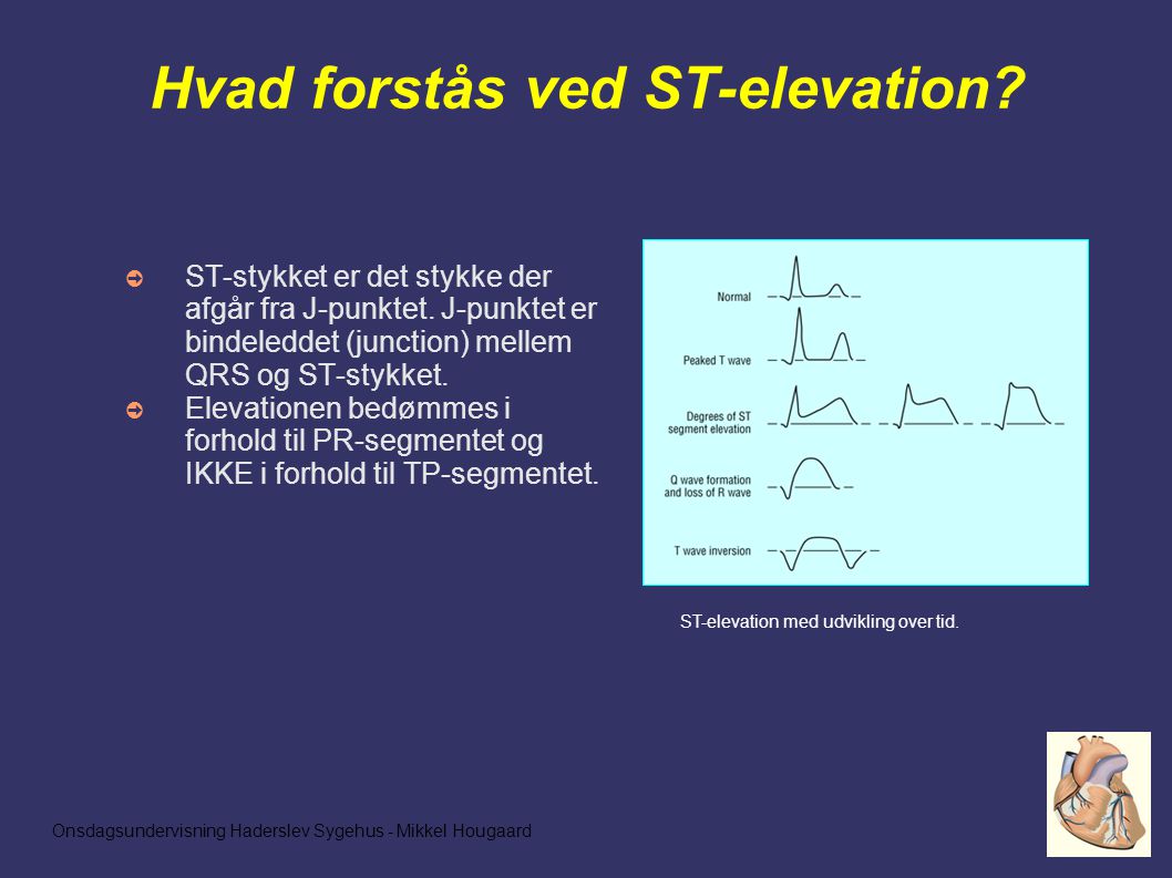 Onsdagsundervisning Haderslev Sygehus - Mikkel Hougaard Hvad forstås ved ST-elevation.