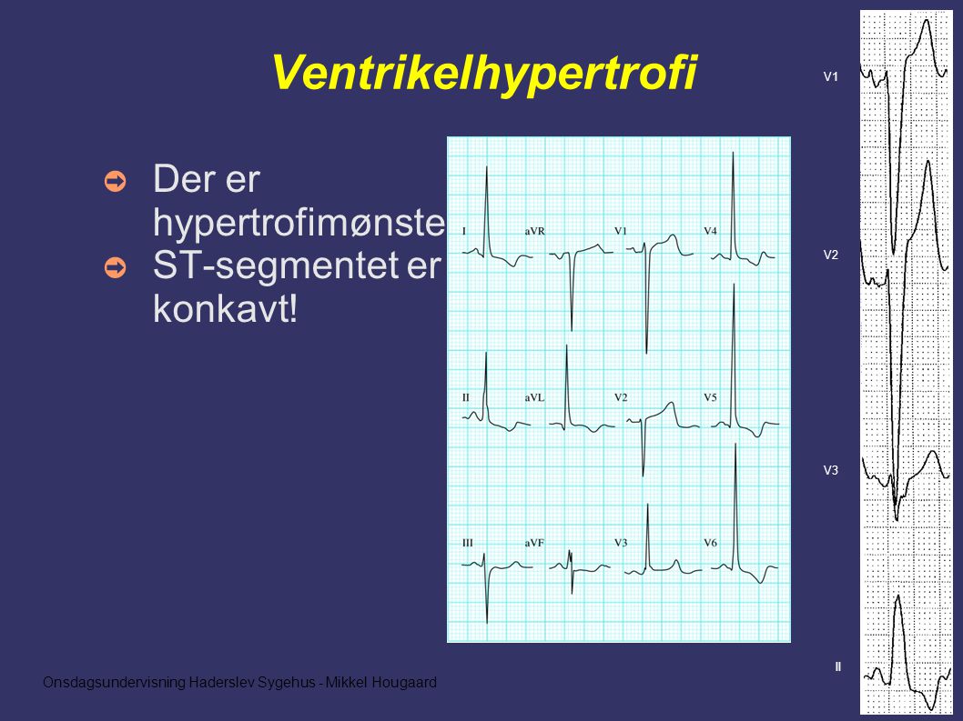 Onsdagsundervisning Haderslev Sygehus - Mikkel Hougaard Ventrikelhypertrofi ➲ Der er hypertrofimønster ➲ ST-segmentet er konkavt.