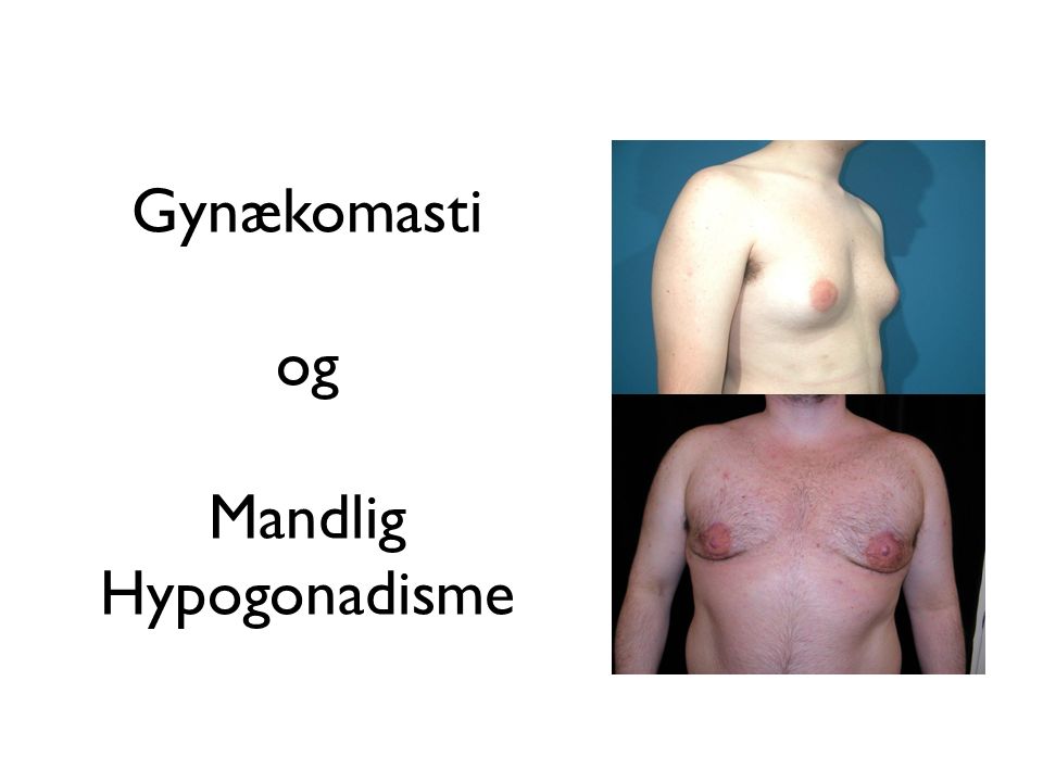 Gynækomasti og Mandlig Hypogonadisme