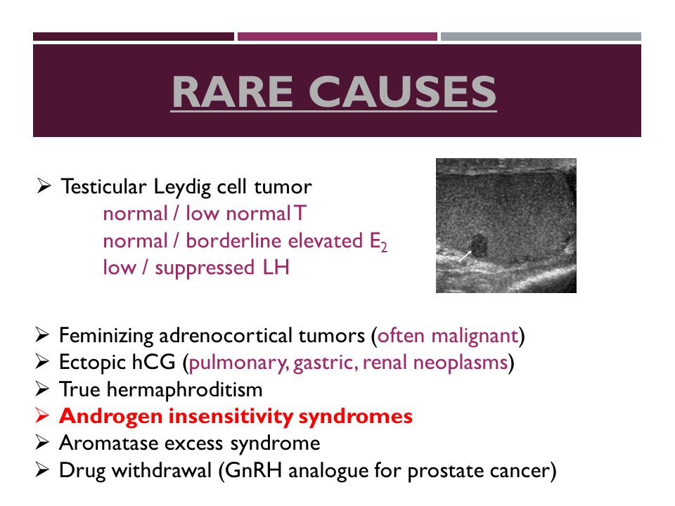 RARE CAUSES  Testicular Leydig cell tumor normal / low normal T normal / borderline elevated E 2 low / suppressed LH  Feminizing adrenocortical tumors (often malignant)  Ectopic hCG (pulmonary, gastric, renal neoplasms)  True hermaphroditism  Androgen insensitivity syndromes  Aromatase excess syndrome  Drug withdrawal (GnRH analogue for prostate cancer)
