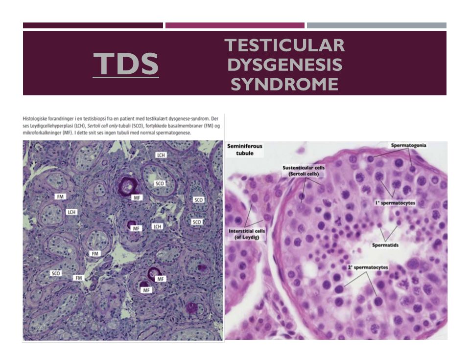 TDS TESTICULAR DYSGENESIS SYNDROME