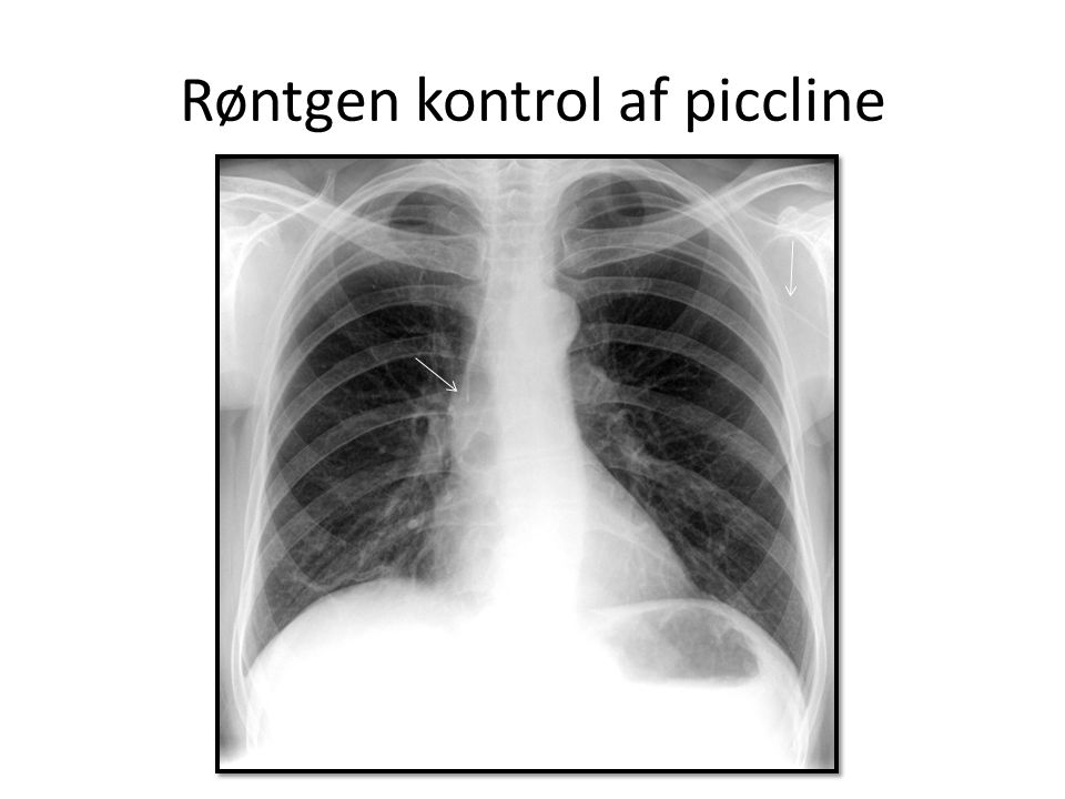 Røntgen kontrol af piccline