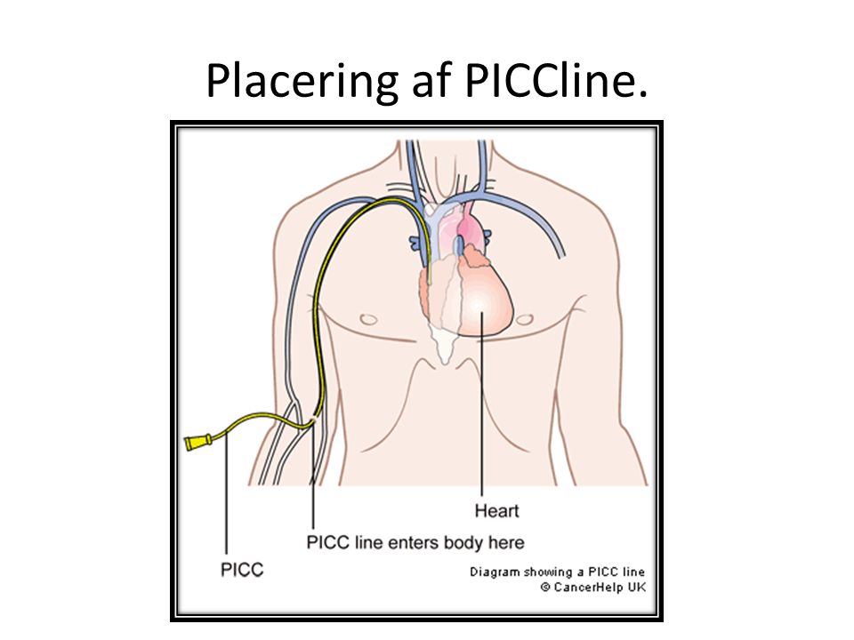 Placering af PICCline.