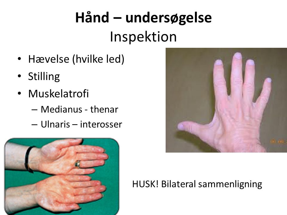 Hånd – undersøgelse Inspektion Hævelse (hvilke led) Stilling Muskelatrofi – Medianus - thenar – Ulnaris – interosser HUSK.