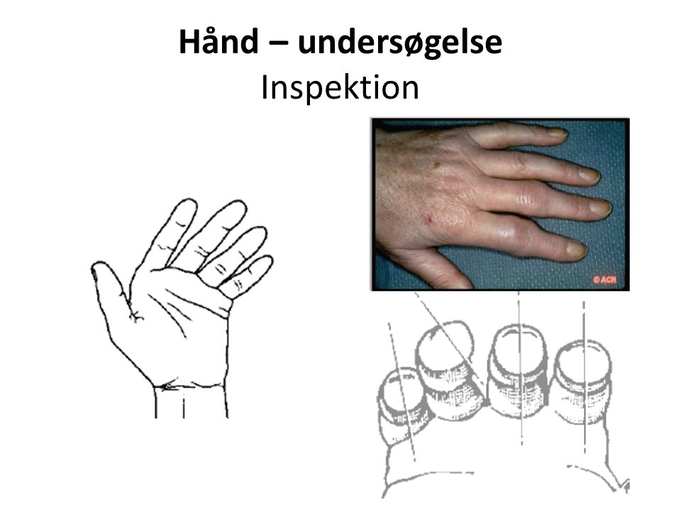 Hånd – undersøgelse Inspektion