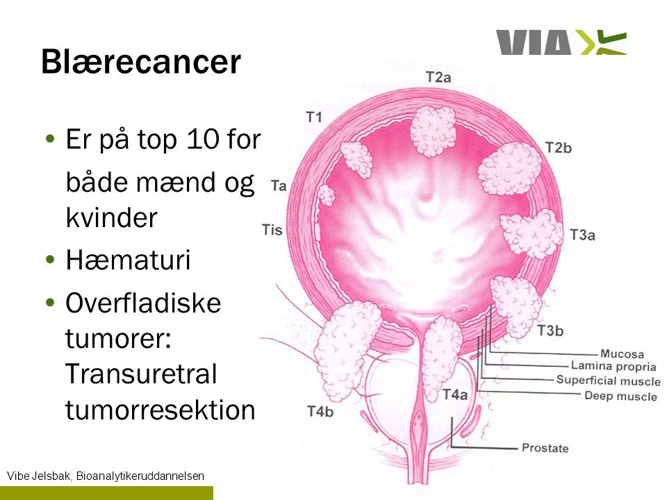 Blærecancer Er på top 10 for både mænd og kvinder Hæmaturi Overfladiske tumorer: Transuretral tumorresektion Vibe Jelsbak, Bioanalytikeruddannelsen